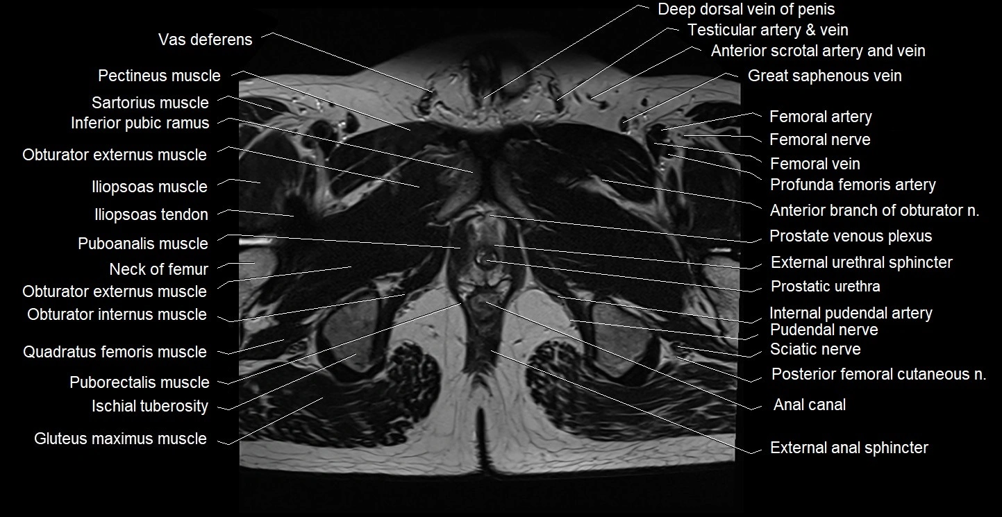 Male pelvis axial cross sectional anatomy image 38.webp